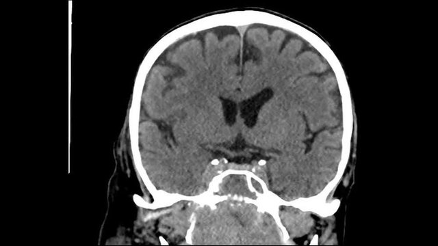 Ct Brain with of Throat cancer. front view