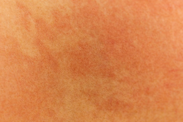 Blurred of skin human have red rash from allergies.