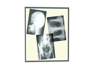 Röntgenschirm mit Röntgenbildern