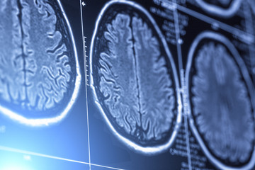 Abstract image with blue light effect effect of MRI or magnetic resonance image of head or scull...