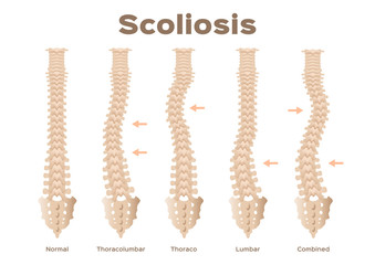 type, scoliosis medical anatomical vector / backbone / organ - obrazy, fototapety, plakaty
