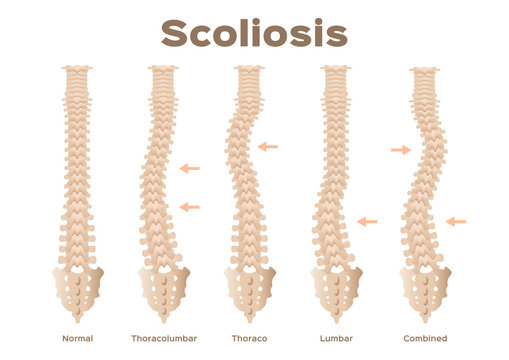 type, scoliosis medical anatomical vector / backbone / organ