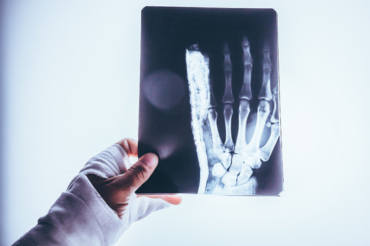 X-ray picture of the hand on the lumen