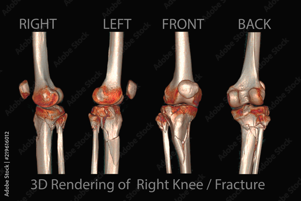 Poster radiological image of the right knee computed tomography (ct) , 3d rendering image.