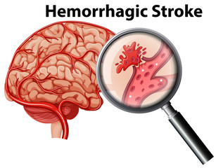 A human anatomy hemorrhagic stroke