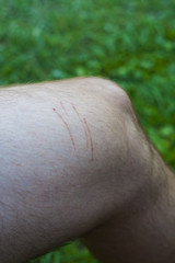 Fototapeta premium cat scratch injury on man foot skin