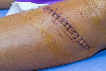 scar from operation suture with a blue fiber at leg patient