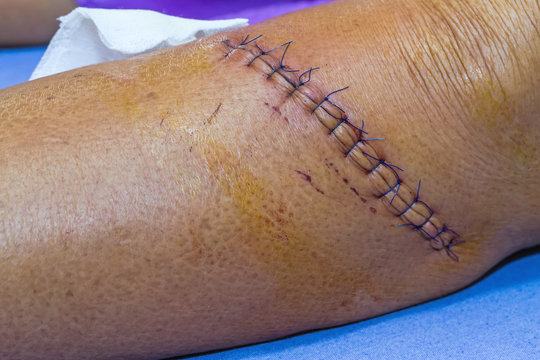 scar from operation suture with a blue fiber at leg patient