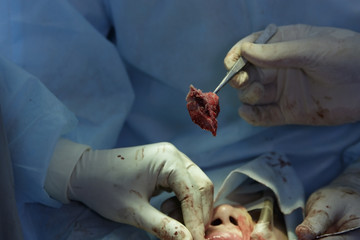 A piece of tumor cartilage close-up during the maxillofacial sugery