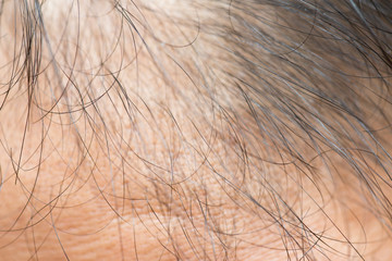 A middle-aged man with hair loss. Baldness