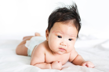 Asian baby girl with red spots on skin face