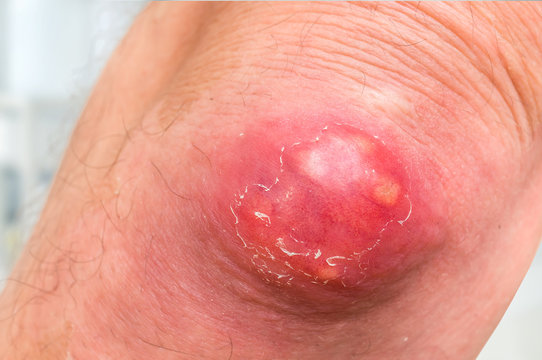 Detailed view of elbow with carbuncle or furuncle