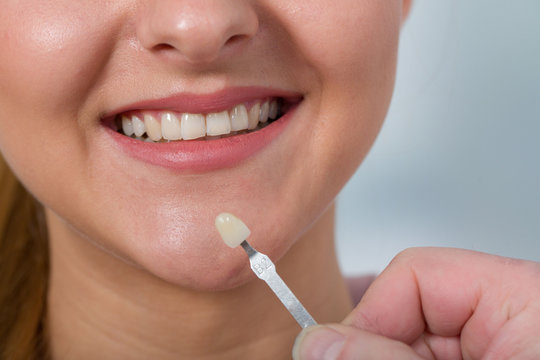 Farbabgleich am Zahn einer jungen Frau für eine Zahnkrone