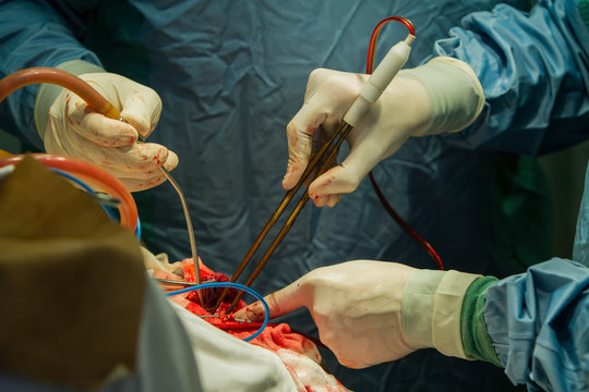 Close-up of the hands of surgeons holding pliers and suction, during trepanation of the skull.