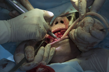 Surgeon drills the jaw during the maxillofacial surgery close-up
