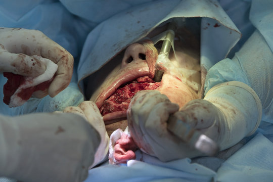 Facial surgery close-up with stretched mouth and removing cartilage