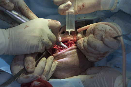 Surgeon uses syringe to wash out the mouth during the maxillofacial surgery close-up