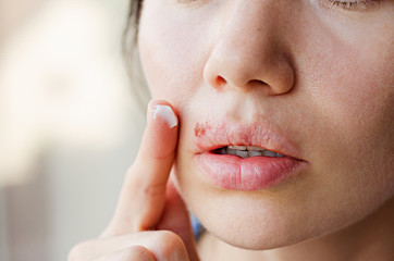 Part of a young woman's face with a virus herpes on lips, treatment with ointment