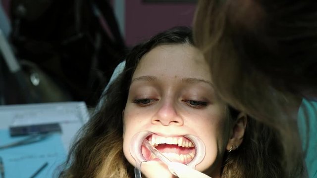 Dentist puts the cotton wool in his mouth, the assistant removes saliva from the saliva ejector before installing the close-up bracket system. Visit to the orthodontist