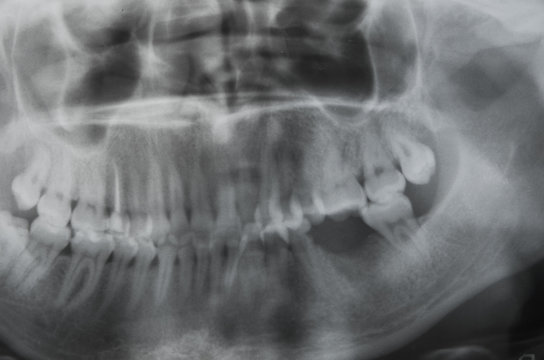 a photograph of teeth, an x-ray, a roentgen of teeth in a patient in a hospital
