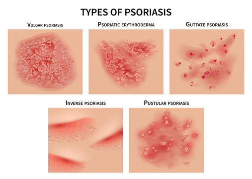 Meglepő pikkelysömör (psoriasis) tünet enyhülések