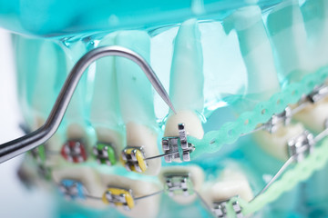 Dental metal brace teeth model