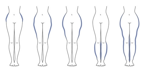 Schaubild Lipödem Flieder