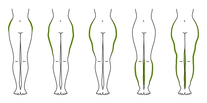 Lipödeme Bilder Durchsuchen 288 Archivfotos, und