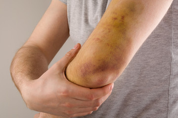 Sport injury.