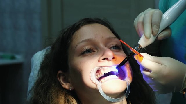 Dentist assistant shines with a dental polymerization ultraviolet lamp on the patients teeth close-up. Visit to the stomatologist