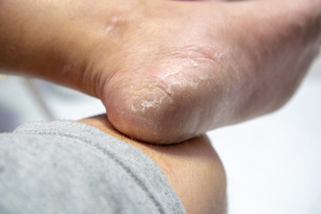 Fototapeta premium Close up Dermatitis of Heel break, Skin peeling in men on foot.