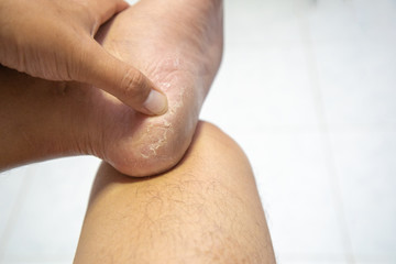 Close up Dermatitis of Heel break, Skin peeling in men on foot.