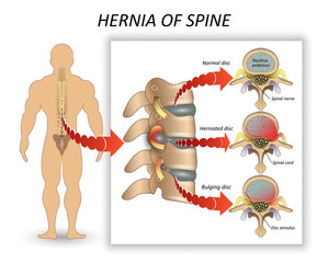Anatomy medical diagram of a human spine with the hernia and description of all sections and segments of the vertebrae. Vector illustration.