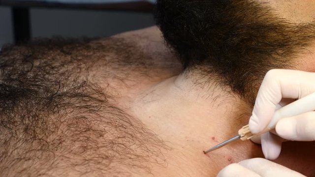 In healthcare clinic. Close up of man getting medical procedure. Cosmetologist in gloves removing mole and Papillomas. 4k