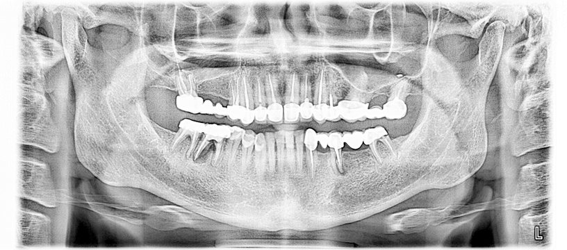 Panoramic X-ray image of upper and lower jaw teeth by tomography. 2D