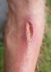 Tiefe Fleischwunde am Schienbein, nach einem Sturz