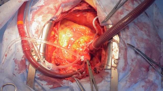 Patient's heart during a surgery. An open heart surgery at a hospital.