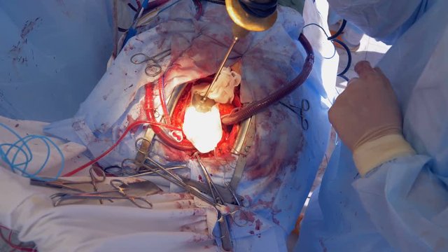 Doctors put gauze on an open heart, top view.