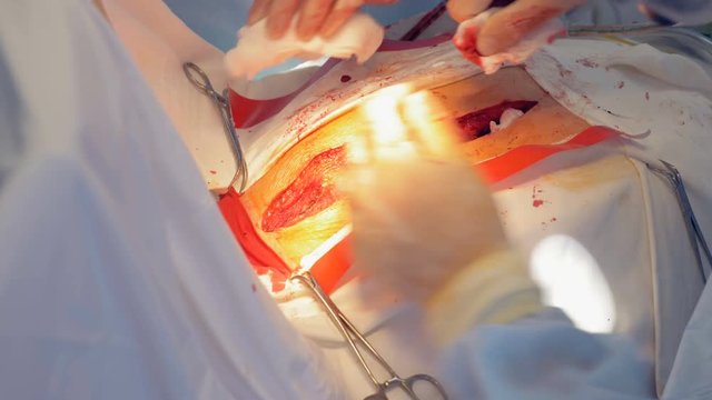 A surgeon cuts a patient's body on a bed, close up.