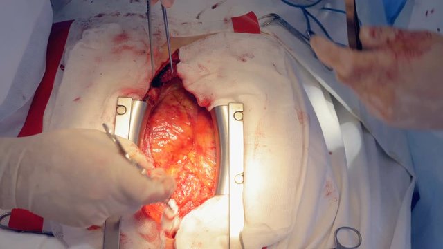 Open heart surgery at a clinic, close up.