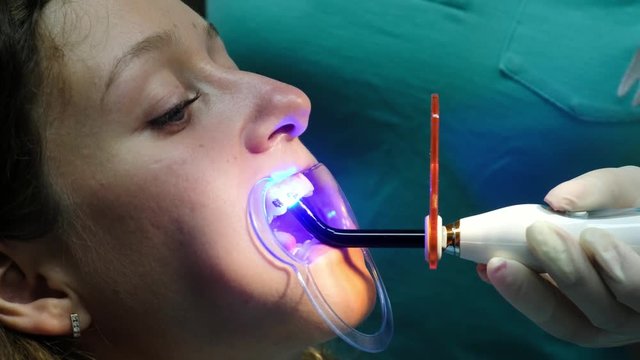 Visit to the dentist, installation of the bracket system. Stomatologist shines with a dental polymerization UV lamp on the braces to the patient close-up.