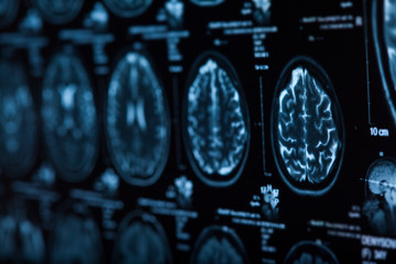The X-ray of the human brain - obrazy, fototapety, plakaty