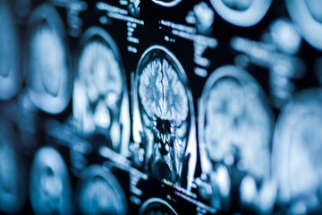 The X-ray of the human brain