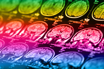 The X-ray of the human brain