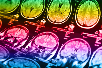 The X-ray of the human brain