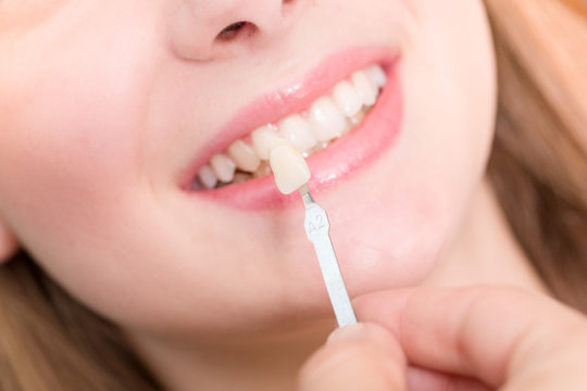 Farbe für Zahnersatz wird am Mund einer Patientin abgeglichen