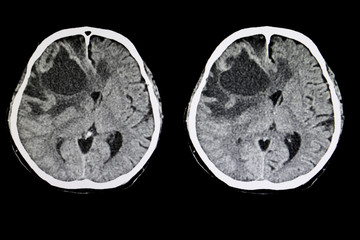 metastatic brain tumor