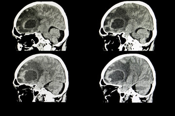 metastatic brain tumor - obrazy, fototapety, plakaty