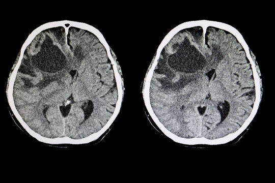 Metastatic Brain Tumor