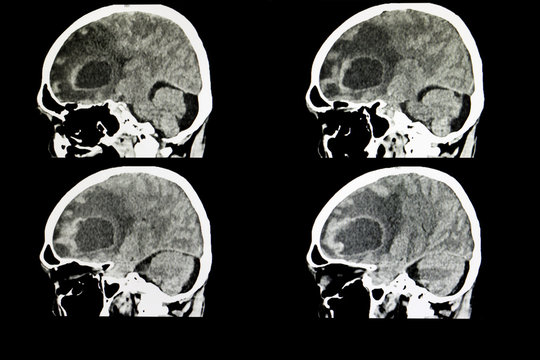 metastatic brain tumor